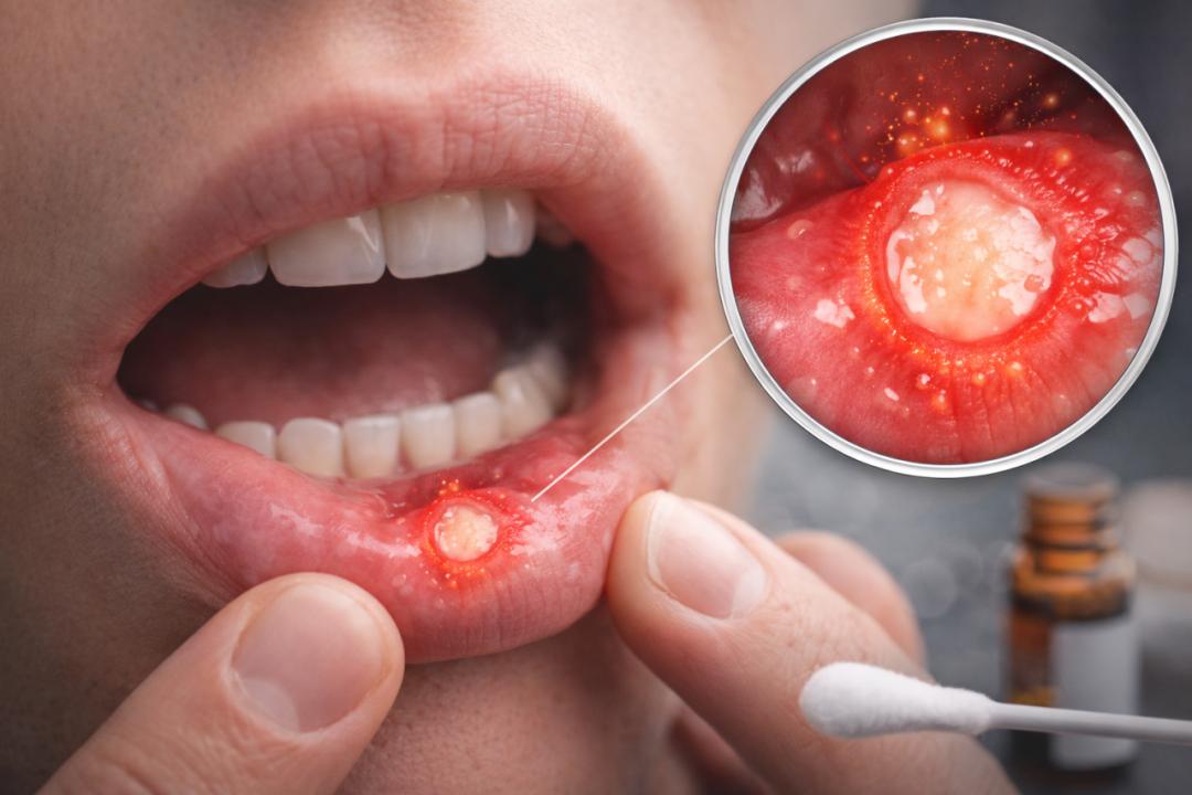 Qu’est-ce qu’un aphte buccal ? Quand faut-il le prendre au sérieux ?