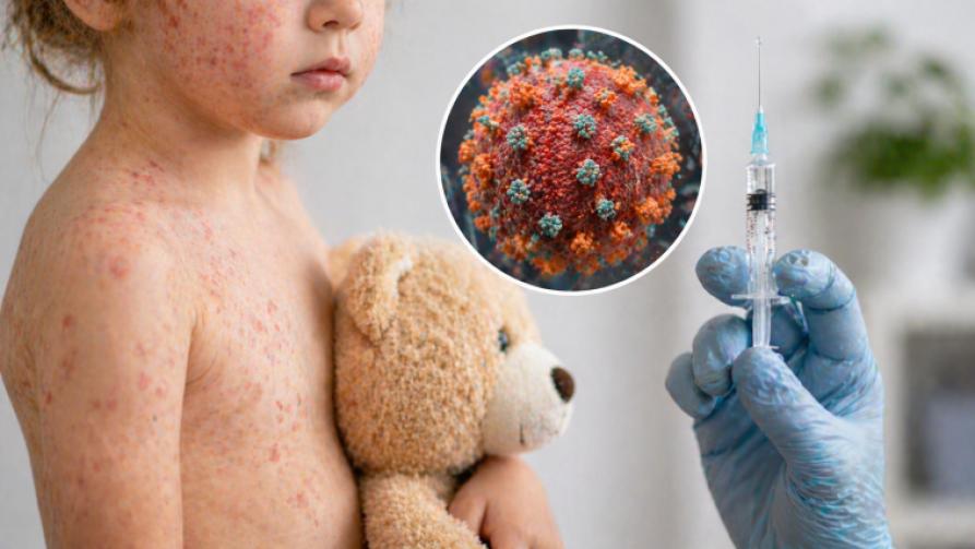 Qu’est-ce que la rougeole ? Pourquoi la vaccination est-elle importante ?