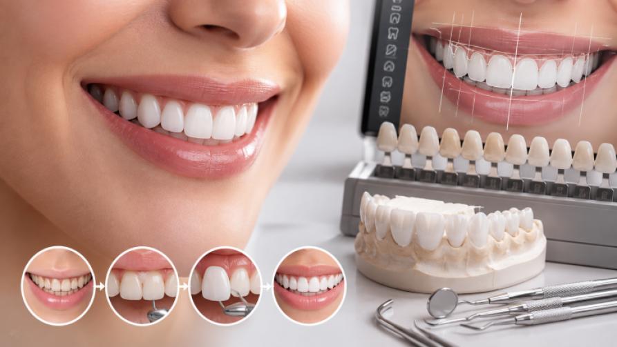 Qu’est-ce que le sourire esthétique ? Comment est-il réalisé ?